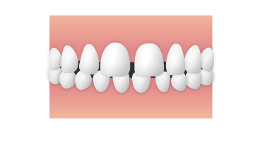 すきっ歯（両前歯の間に隙間がある状態）