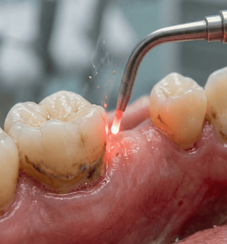 Er:YAGレーザー 歯周病治療 歯石除去